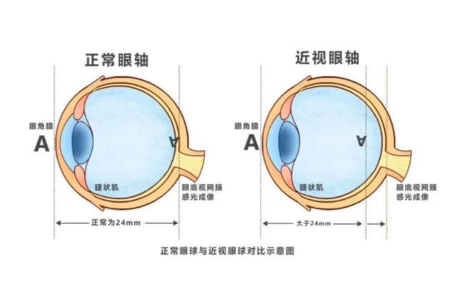 高度近视不只是看不清！警惕眼底的“隐形危机”