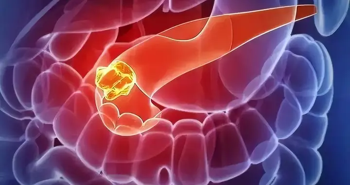 别再把腰痛当骨病！胰腺癌的4个早期信号别忽视，早期发现是关键