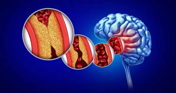 频繁忽视警示！52 岁阿姨脑出血偏瘫，医生：叮嘱全当耳旁风