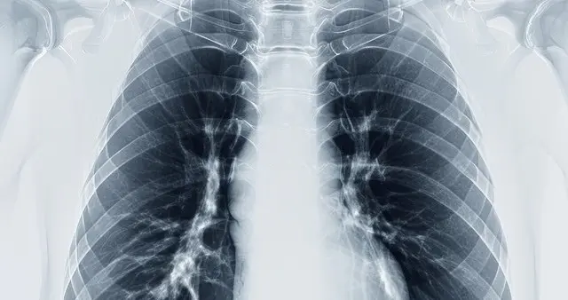 真神奇！高达七成肺癌患者有望临床治愈！它有何过人之处