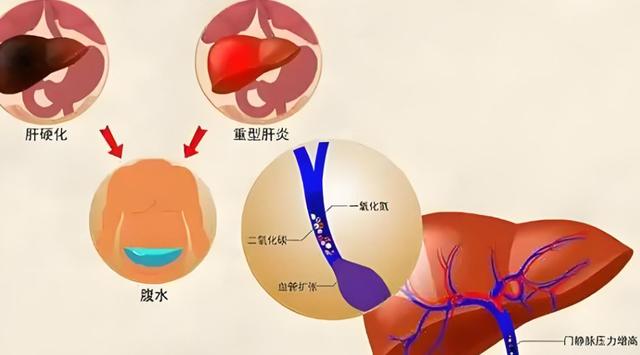 肝硬化腹水预警！身体出现这4个异常，千万别忽视！