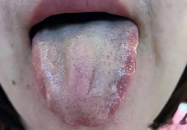 爱长肺结节的人，千万不能让自己白挨一刀！很多人后悔没早点知道