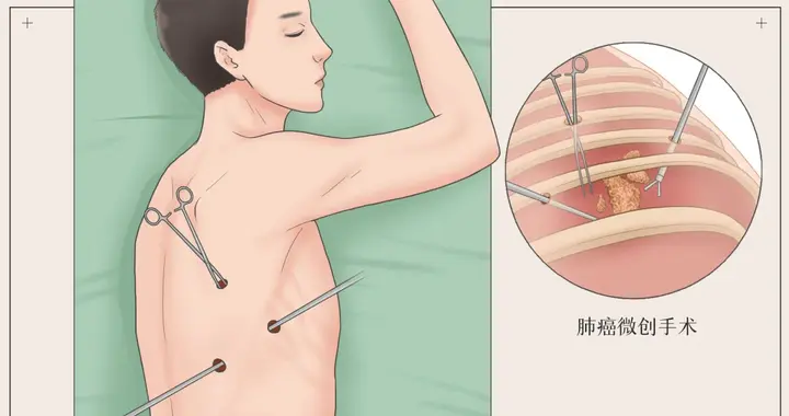 肿瘤手术切除后的真相，癌细胞扩散速度加快70%