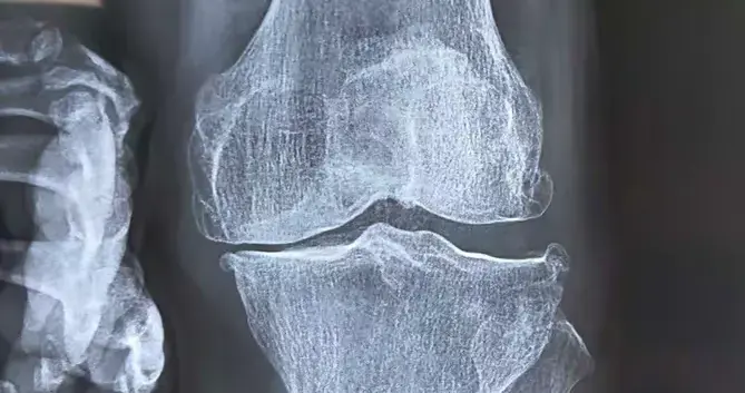 那个几乎要换膝盖的教师，最后怎么样了？行医40年，我见证的逆转