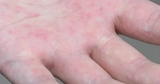 疱疹治疗重大突破！首个外用药，强效克服耐药，快速缓解，更安全
