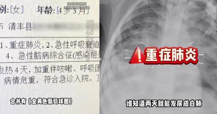 4岁女童24小时变“白肺”，这些信号提示混合感染！