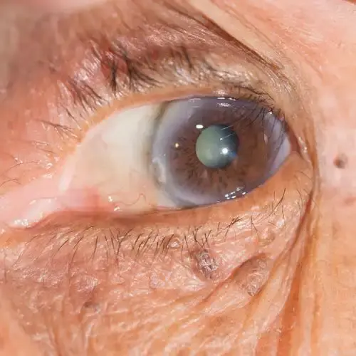 上海眼科院长：高度近视合并老花眼和白内障，如何矫正视力呢？