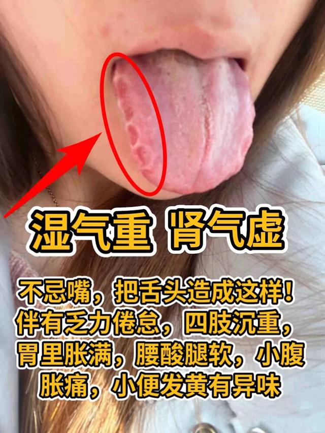 潘医生舌诊—实战分析：湿气重、肾气虚不忌嘴，把舌头造成这样!
