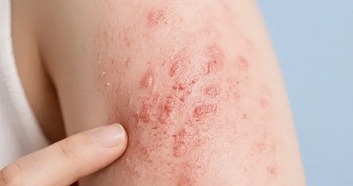 湿疹反复不愈是癌前信号？医生提醒：出现这3种皮肤变化要查！