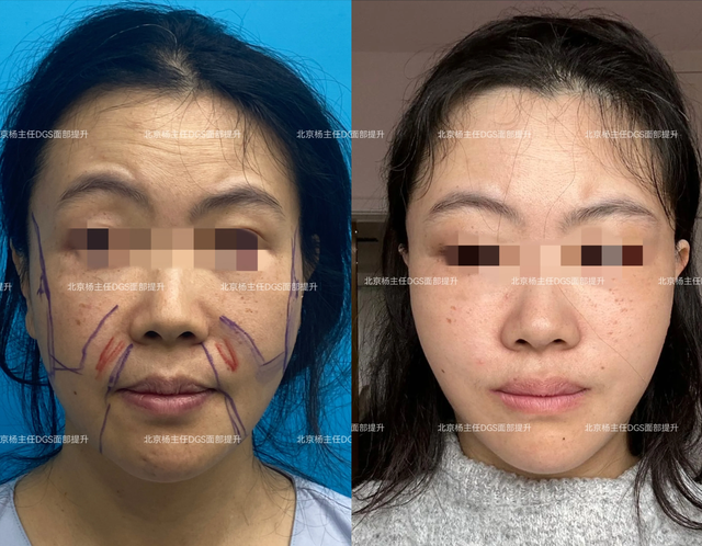 43岁女士，人生第一次做拉皮提升，术后60天，像换了一张脸！