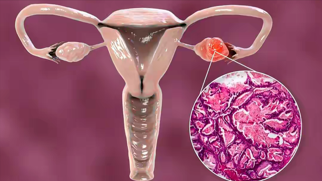 卵巢癌一发现就是晚期？医生忠告：下半身有这4种异常，一定小心