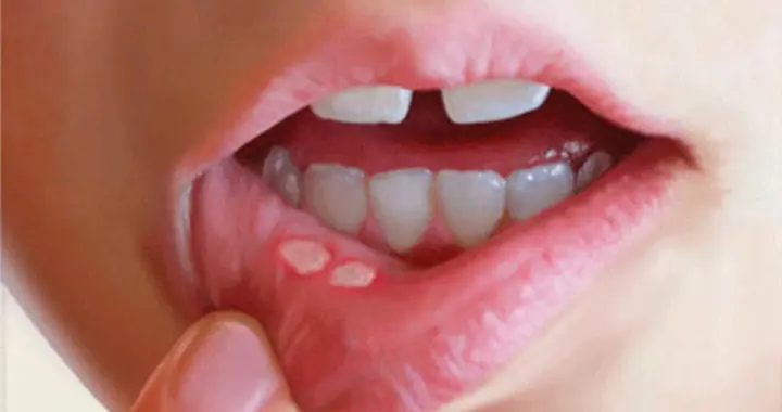 你以为是上火，实际却是癌症！这5种症状，每一个都要重视