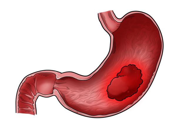 这5件日常小事，正在悄悄“喂养”癌细胞，现在改还来得及！