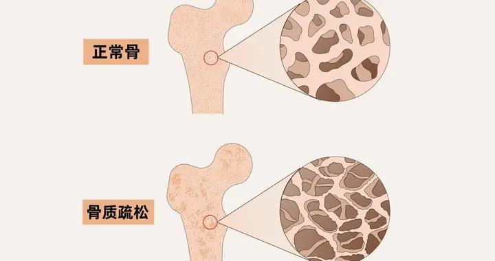 骨质疏松要不要补钙？