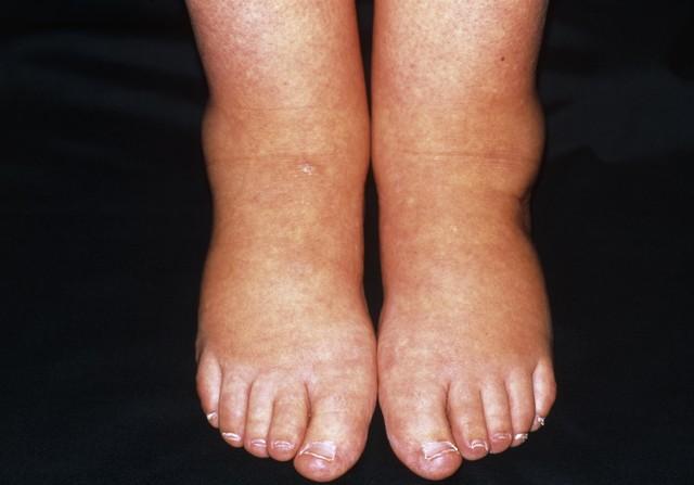 出现双下肢水肿，当心是心力衰竭的“信号”，老年人要提高警惕