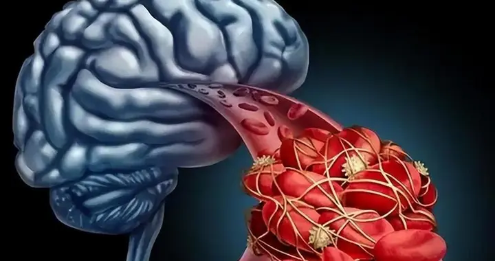 医生调查发现：脑梗塞患者若每天睡午觉，不用多久，或有6个变化