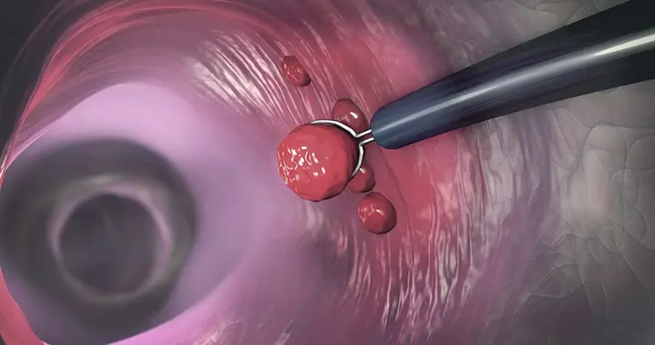 肠癌专挑这3类人“下手”！医生提醒：肠镜别再硬拖，真能救命！