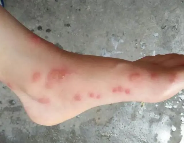 湿疹用药组合：莫匹罗星软膏联合丁酸氢化可的松软膏