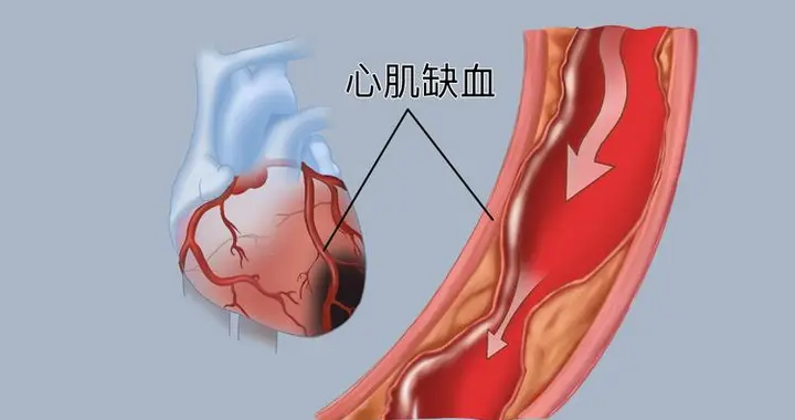 心肌缺血是心脏发出的求救信号，听懂这个信号，避免悲剧发生