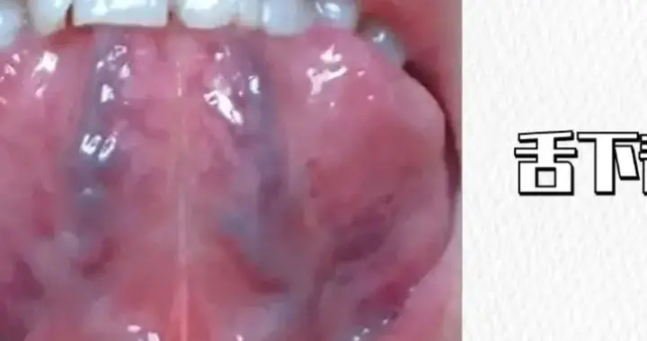 姐妹们，舌下青筋粗、双腿发沉别忽视！3个简易穴位化开全身淤堵