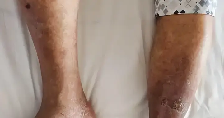 肠菌移植如何改善糖尿病皮肤问题？降低慢性炎症是关键