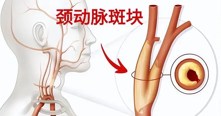 我国有上千万人做颈动脉超声！医生：做一次颈动脉超声，或管三年