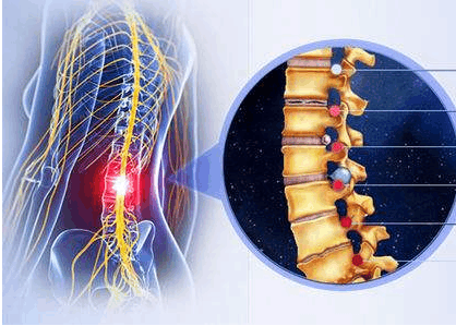 在生活中要注意以下几点可以有效的预防腰突 
