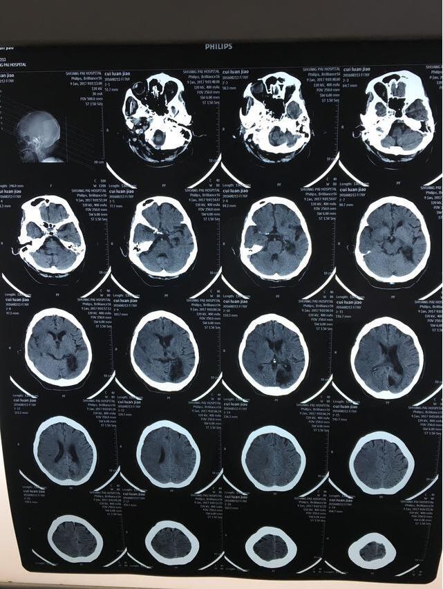 一患者大面积脑梗死的头部ct图片