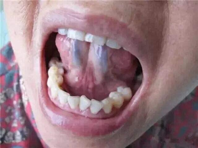 假如指甲,嘴唇都有青紫色的症状,那几乎可以确定,心脏一定有气滞血瘀