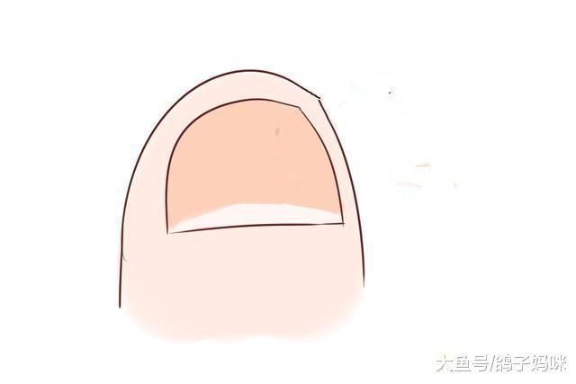 女婴剪脚趾, 化脓引发败血症;指甲剪不对宝宝遭罪!