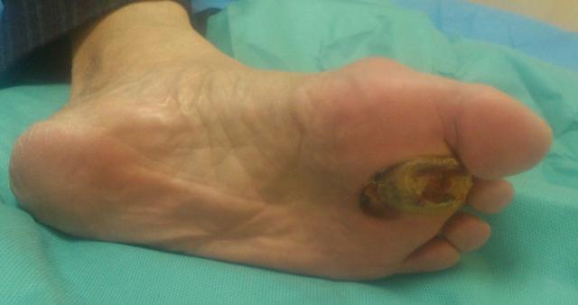 医生告诫: 脚趾有这3个特征, 90%都得了糖尿病, 早发现早救命!