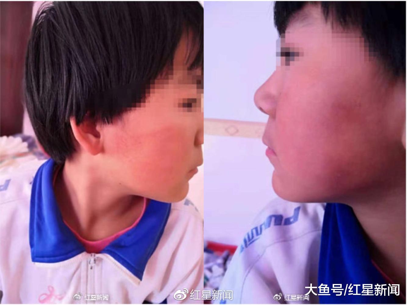 “甘肃八岁女生遭掌掴后突发性耳聋”追踪: 警方已立案调查