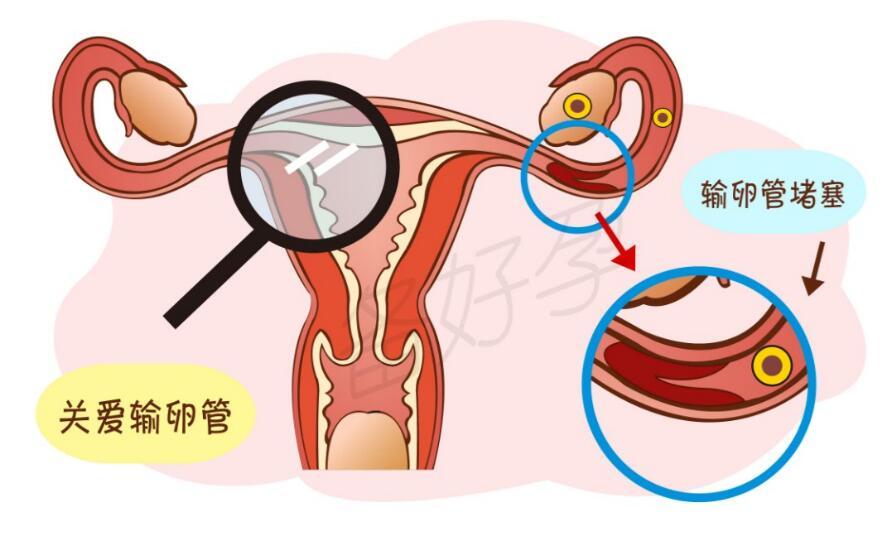 巧克力囊肿损伤卵巢, 育龄女性如何预防?