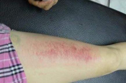 年轻女子内分泌失调, 亲戚为其刮痧, 看完刮出的东西赶紧报了警!