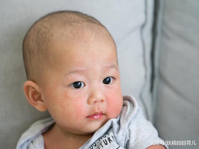 如何预防宝宝异位皮炎, 冬季护理做好这5点很重要
