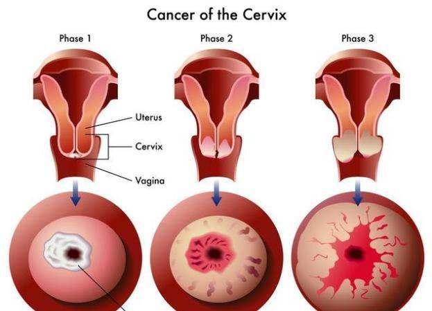 23岁女孩远嫁非洲, 两年后下身异常出血, 医生摇头说无药可救!