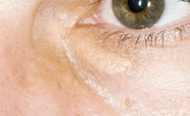 血脂高不高, 看3个部位就知道! 喝水时加点“它”, 血脂缓缓下降