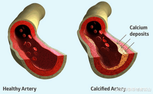 血管钙化的原因 血管钙化是导致心脏病的重要原因 Causes Of Calcification In Soft Tissues 