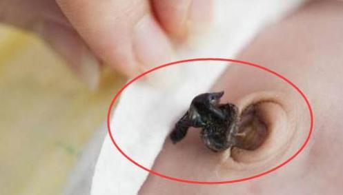 肚脐里面的脏东西究竟能不能抠, 纠结这么久, 今天终于有答案了!