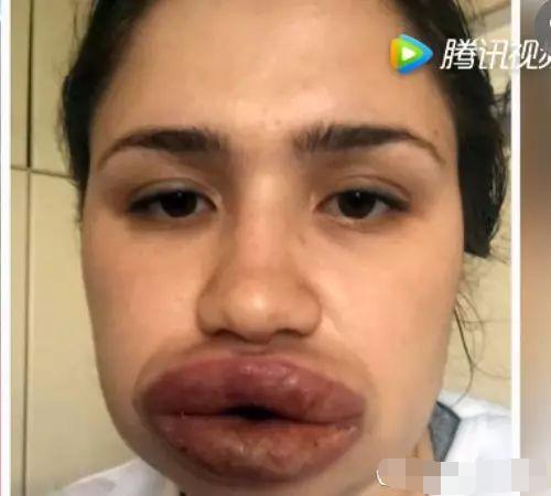 女子贪便宜, 低价请非专业人士帮忙整容, 结果整成了香肠嘴