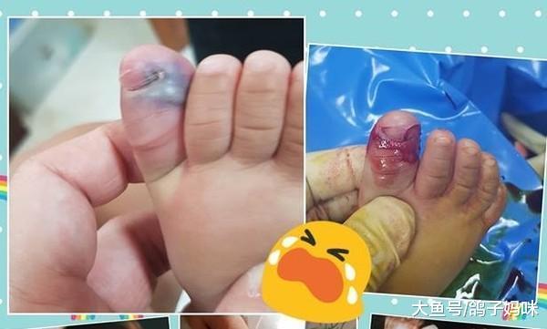 女婴剪脚趾, 化脓引发败血症;指甲剪不对宝宝遭罪!