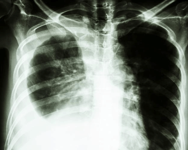 43岁女工人咳嗽3个月, 查出肺癌晚期, 医生叹息: 你来太晚了!