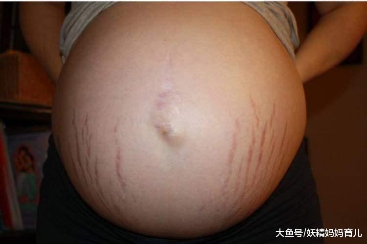 明星生娃没有妊娠纹的10个小窍门, 你也值得拥有