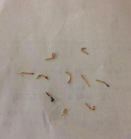 男子去泰国纹身, 回来后背部持续疼痛, 医院检查取出东西令人费解