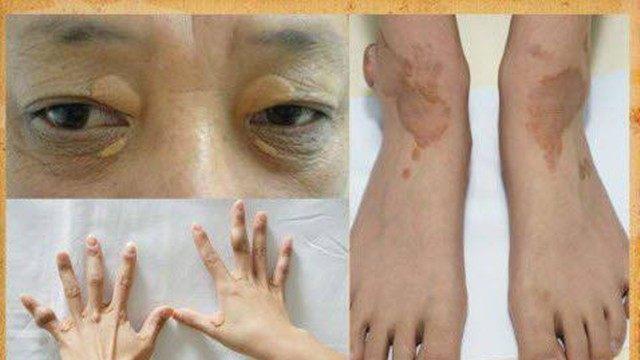 身体1处发麻, 1处发白, 3处发黄, 这是高脂血症的表现, 要警惕!