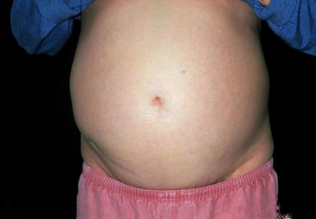 21岁花季少女查出卵巢癌离世, 医生提醒: 日常生活中要注意五点