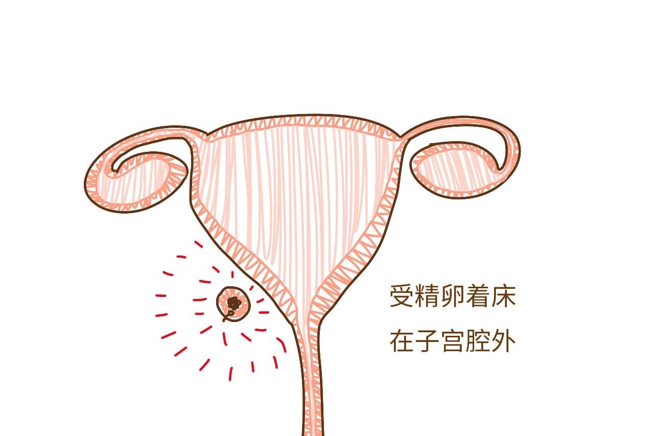 不幸的宫外孕, 是这些原因造成的, 看了第2个男人们该反思