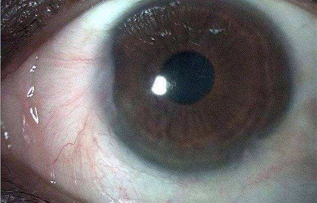 身体1处发麻, 1处发白, 3处发黄, 这是高脂血症的表现, 要警惕!