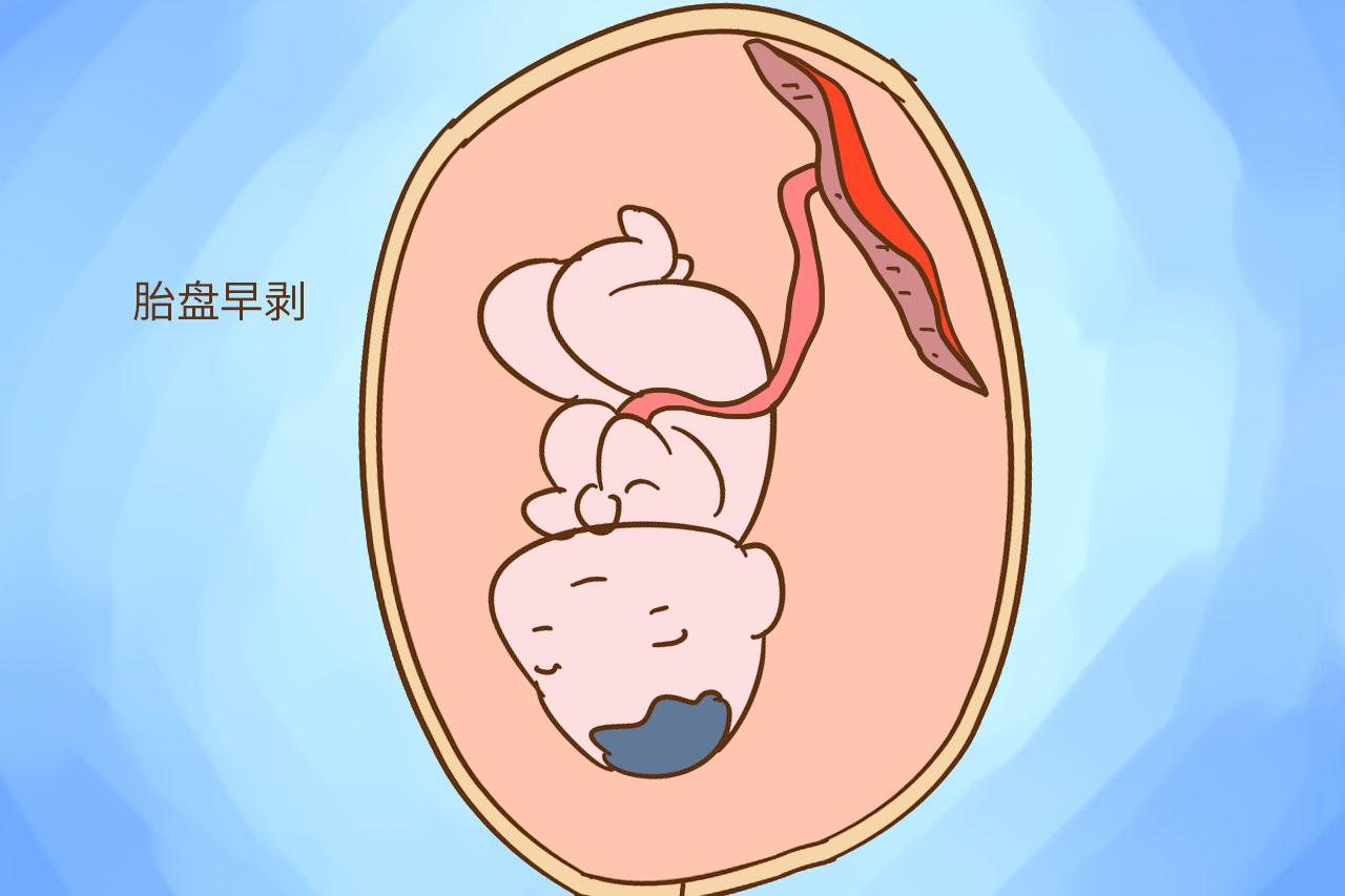 生孩子很怕出现这2种情况, 眨眼间顺产变难产