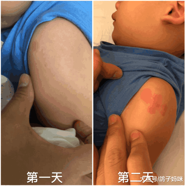 误以为感冒, 妈妈讲述儿子川崎病的亲身经历!